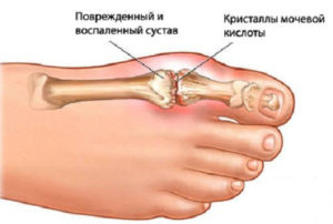 Подагра - все про масаж