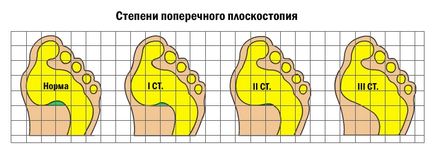 Transversal simptome picioarele plat și de tratament