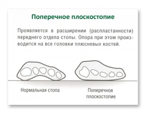 Transversal simptome picioarele plat și de tratament