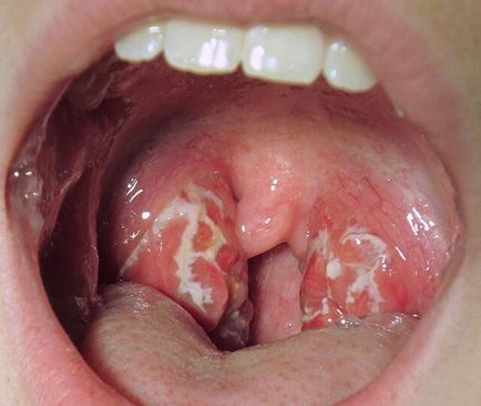 A vereség a mandulák lehet az egyetlen megnyilvánulása gonorrhoea