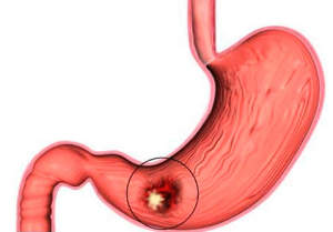 Starea precanceroasă a semnelor și tratamentului stomacului