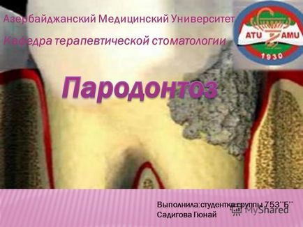 Előadás a periodontitis (alveoláris csont) Előadás a fogágybetegség
