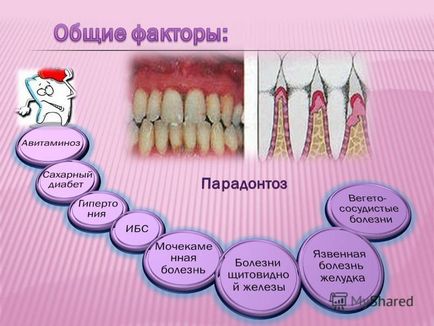 Bemutatása a periodontális betegség (a csont az alveoláris csont) Előadás a fogágybetegség