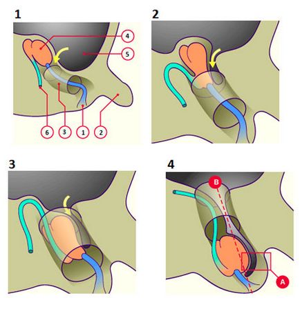 Cauzele căderii cauzate de caracteristicile anatomice ale apendicelui peritoneului
