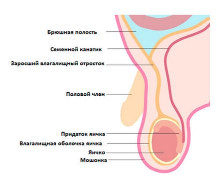 Cauzele căderii cauzate de caracteristicile anatomice ale apendicelui peritoneului