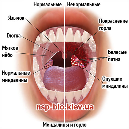 Aplicații badus nsp la amigdalită cronică