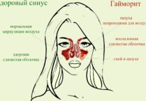 Simptomele primelor simptome ale sinuzitei în cazul în care doare