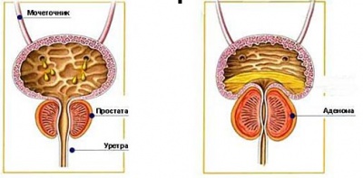 Prostatul este a doua inima a unui om, chymmed este un site medical pentru medici si pacienti