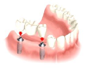 Stomatologie protetică în Tyumen, inserați proteze dentare la medicul dentist-ortopedist din Unimed