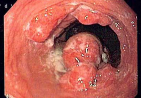 Рак гортані і гортаноглотки, система «онконет»