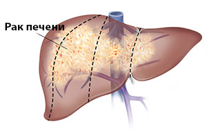 Рак печінки - пухлини печінки