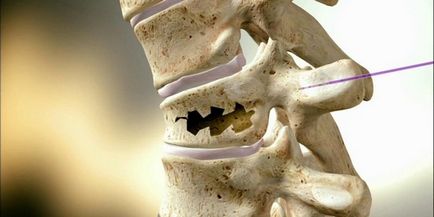Reabilitarea după o fractură de compresie a gimnastică terapeutică a coloanei vertebrale, corsete - vii sănătoase
