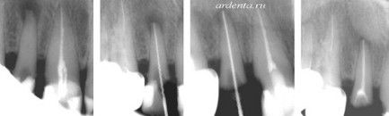 Retrográd periodontiíissei okok, tünetek, jelek, diagnózis és kezelés