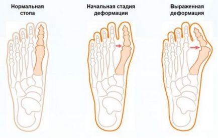 Conuri pe partea din afara piciorului