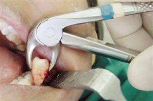 Складне видалення зуба