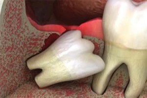 Dificultatea extracției dinților are o intervenție chirurgicală