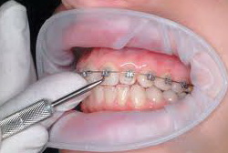 Îndepărtarea parantezelor este rezultatul tratamentului ortodontic