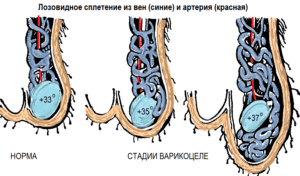 varicocele szakaszban és az 1., 2., 3. és 4. fok varicocele férfiak besorolás