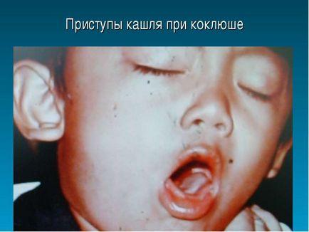 Свистячий кашель у дитини - кілька моментів, про які краще знати, кашель