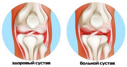 Техніка масажу колінного суглоба при артриті