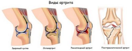 Масаж техника на колянната става артрит