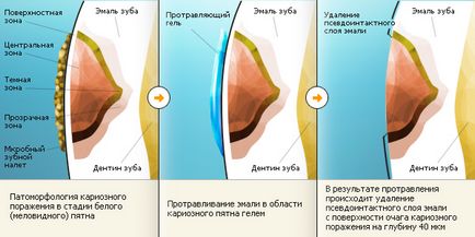 Технології сучасної стоматології, лікування карієсу хіміко-механічними методами, новини