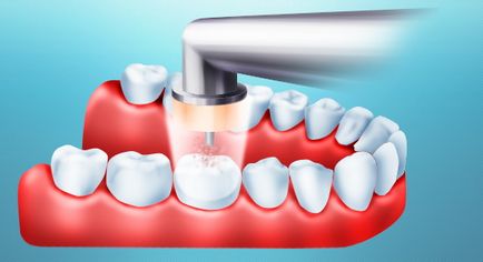 Tehnologii de stomatologie moderna, tratament cariilor cu metode chimico-mecanice, stiri