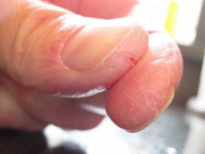 Тріскається шкіра на пальцях рук або ніг - причини і ефективне лікування