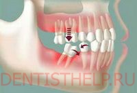 Extracția dintelui - ce consecințe pot avea; complicații după extracția dinților; consultarea medicului