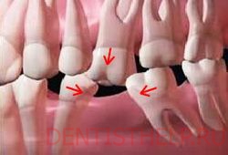 Видалення зуба - які наслідки можуть бути; ускладнення після видалення зуба; консультація лікаря