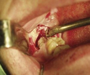 Înlăturarea dinților înlăturați asupra efectelor maxilarului inferior