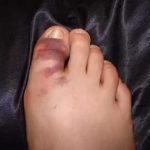 Kificamodott toe tünetei, kezelése a nagy és a kis ujját, nincs ízületi fájdalom