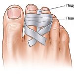 Kificamodott toe tünetei, kezelése a nagy és a kis ujját, nincs ízületi fájdalom