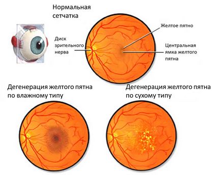 Вікова дегенерація жовтої плями 1