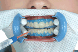 Все про відбілювання зубів