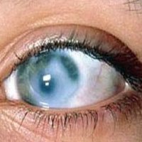 Хірургічне лікування глаукоми - скальпель - медичний інформаційно-освітній портал