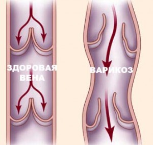 Хміль при варикозі допоможе варикозне розширення вен