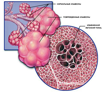 Boala pulmonară obstructivă cronică (hobbl) - clasificare, simptome, metode de tratament și