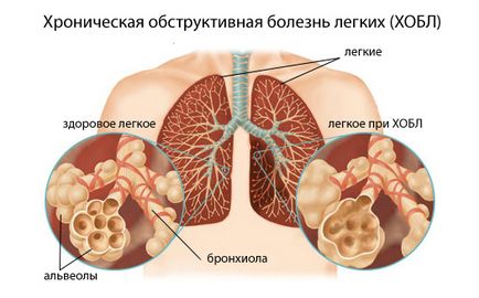 Boala pulmonară obstructivă cronică (hobbl) - clasificare, simptome, metode de tratament și