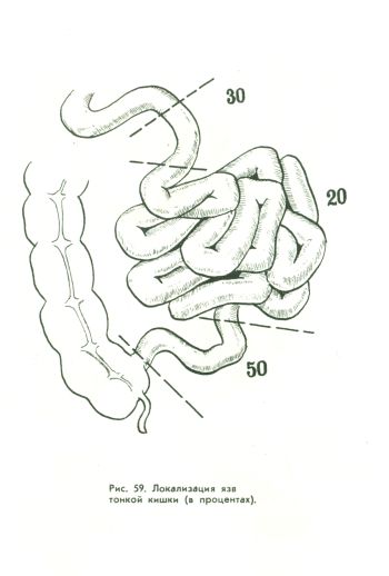 Ulcerul intestinului subțire