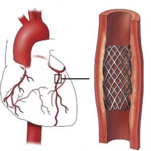 Élet után sztentelése cardiorehabilitation és helyes életmód után stenting