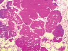 Алвеоларна proteinosis белия дроб, симптоми, диагностика, лечение, профилактика