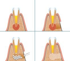 Amputarea rădăcinii dintelui 1