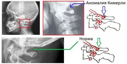 Rendellenességek a nyaki gerinc nyaki borda anomália Kimmerle