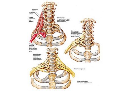 Anomalii cervicale, coaste cervicale, anomalii ale kimmerului