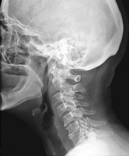 Rendellenességek a nyaki gerinc nyaki borda anomália Kimmerle