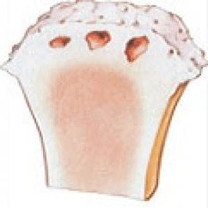 Osteoartrita articulației genunchiului - tipuri și grade de dezvoltare a bolii