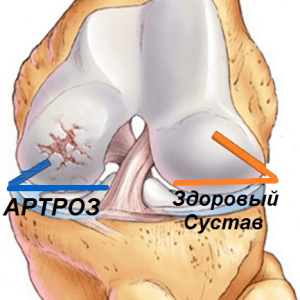 Osteoartrita articulației genunchiului - tipuri și grade de dezvoltare a bolii