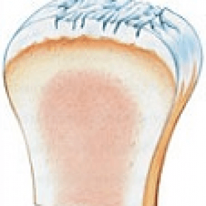 Osteoartrita articulației genunchiului - tipuri și grade de dezvoltare a bolii