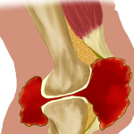Артроз колінного суглоба - види і ступеня розвитку захворювання